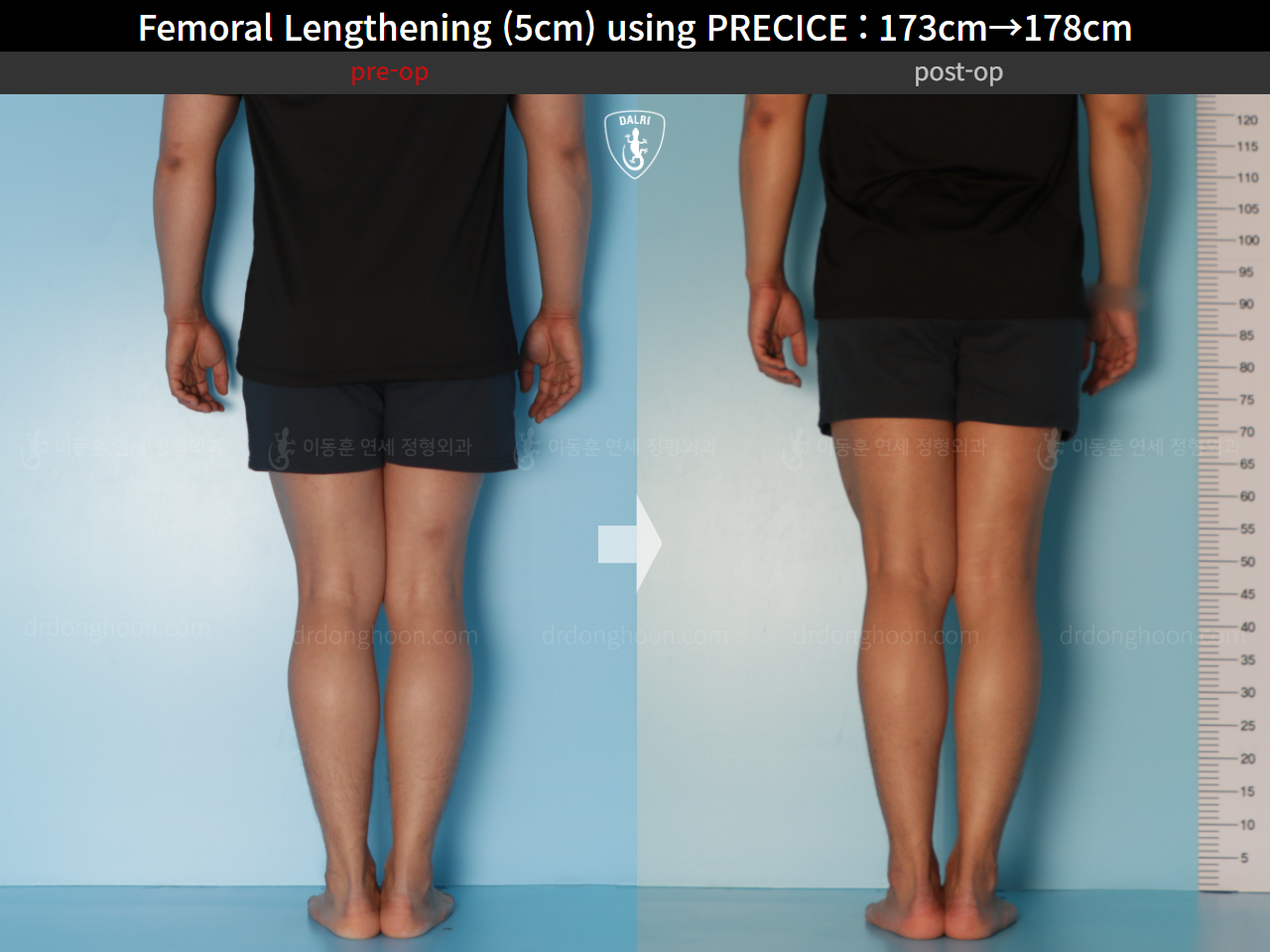 Before and after cll precice, case 21702609, image 8, Dr. Donghoon institute (DALRI)