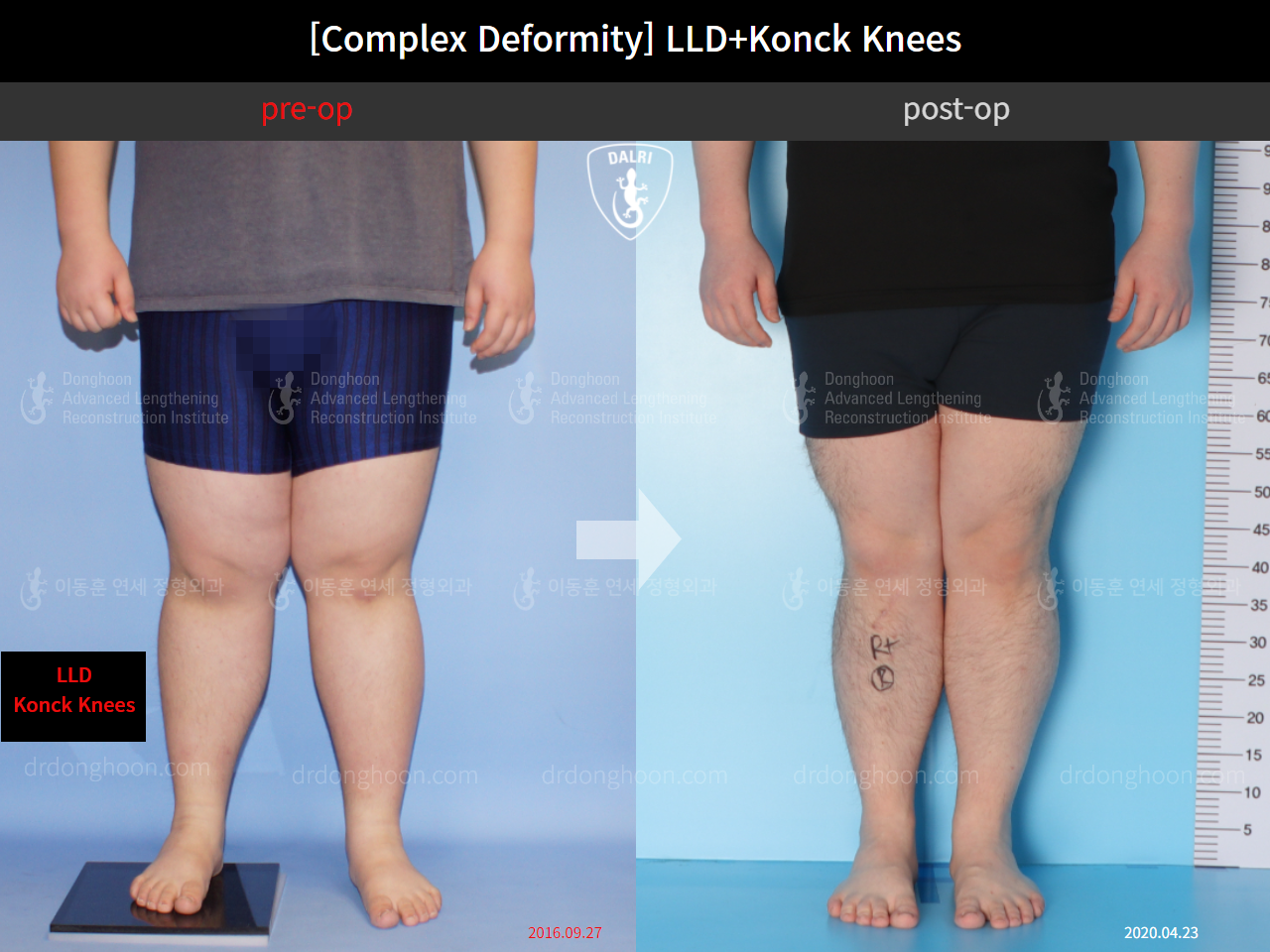 Before and after complex deformity, case 10564251, image 4, Dr. Donghoon institute (DALRI)