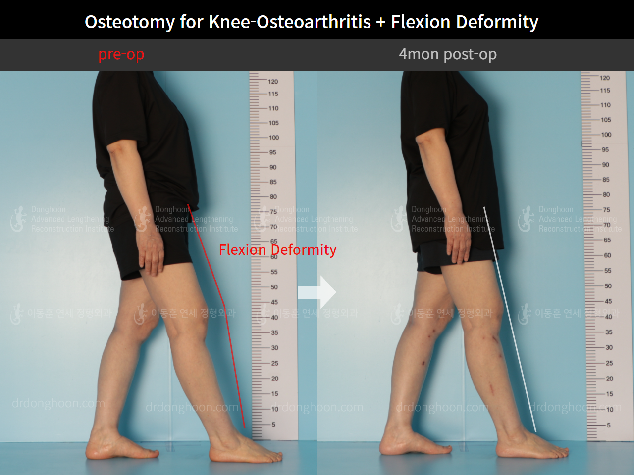 Before and after osteotomy for knee osteoarthritis, case 8803663, image 3, Dr. Donghoon institute (DALRI)