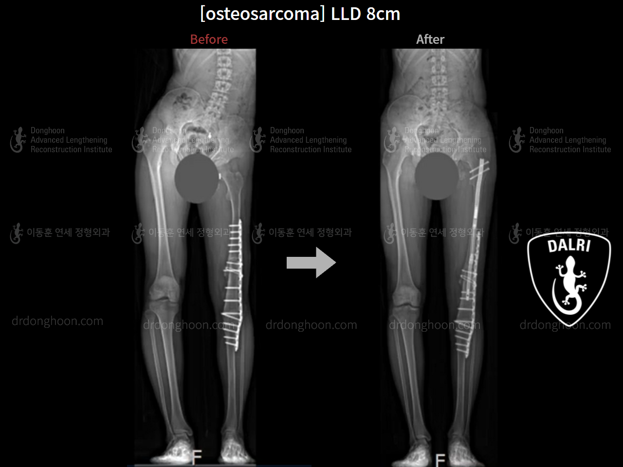 Before and after adult lld, case 9012759, image 2, Dr. Donghoon institute (DALRI)