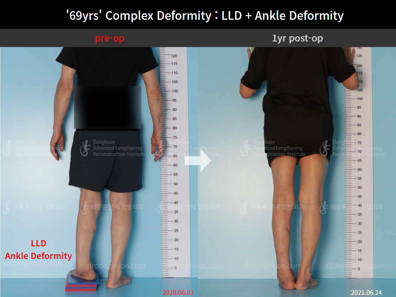 Before and after foot & ankle deformity, case 8981752, image 6, Dr. Donghoon institute (DALRI)