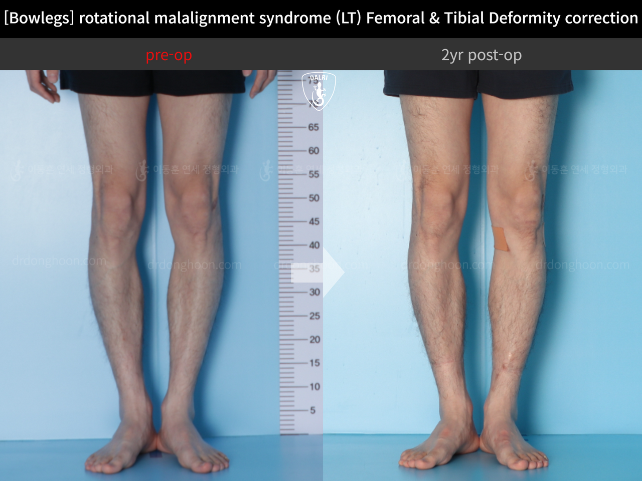 Before and after adult bowlegs, case 13266718, image 8, Dr. Donghoon institute (DALRI)