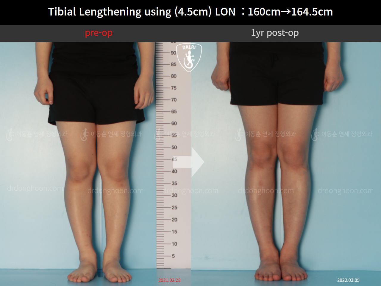 Before and after cll lon, case 10600029, image 5, Dr. Donghoon institute (DALRI)