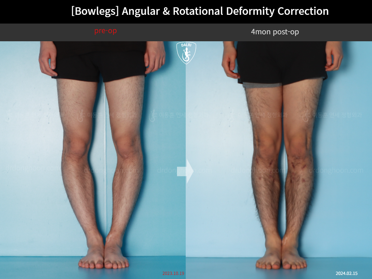 Before and after adult bowlegs, case 18071382, image 6, Dr. Donghoon institute (DALRI)