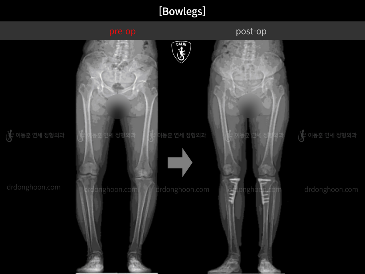 Before and after adult bowlegs, case 13223508, image 8, Dr. Donghoon institute (DALRI)