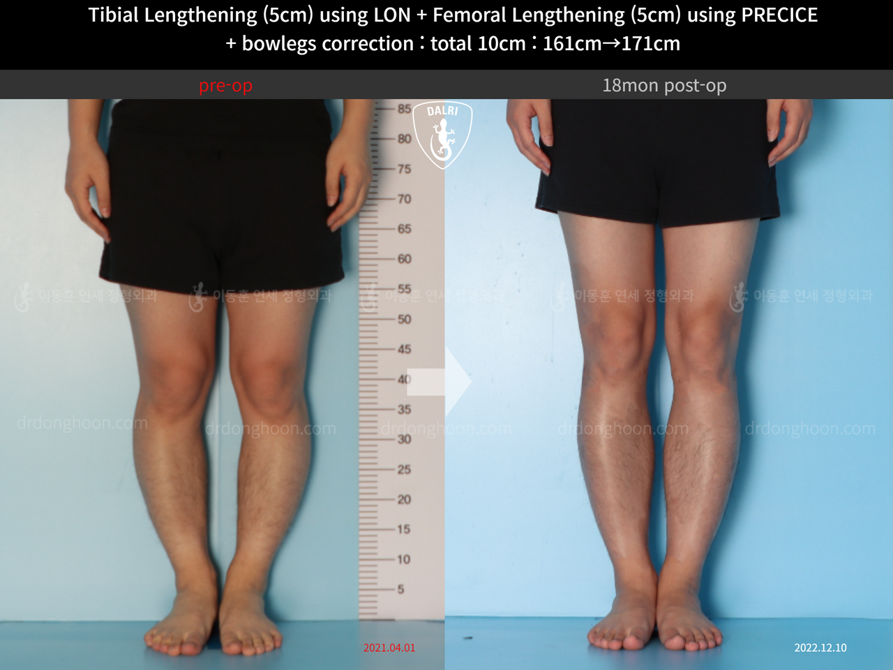 Before and after cll precice, case 13660867, image 7, Dr. Donghoon institute (DALRI)