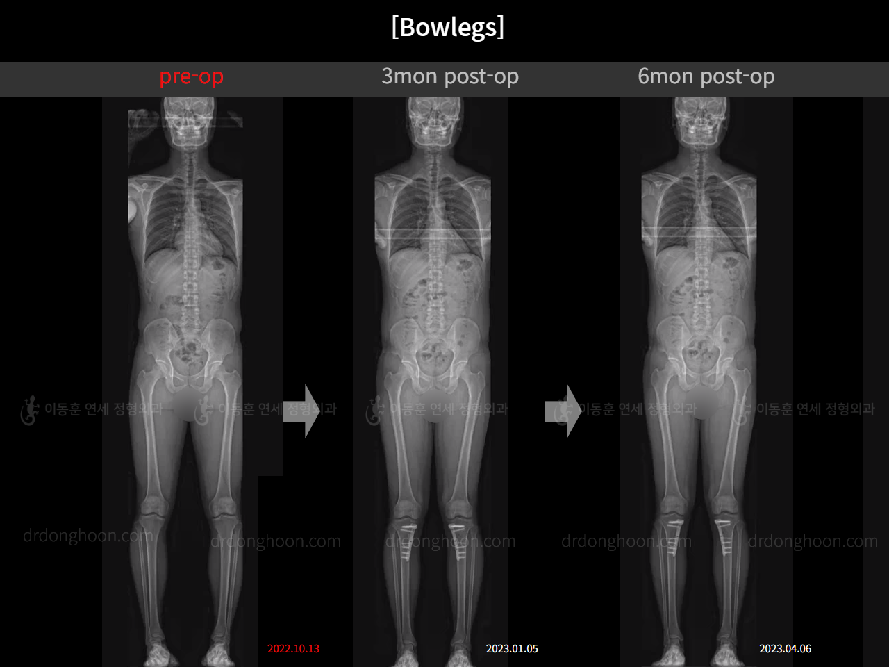 Before and after adult bowlegs, case 14742489, image 9, Dr. Donghoon institute (DALRI)