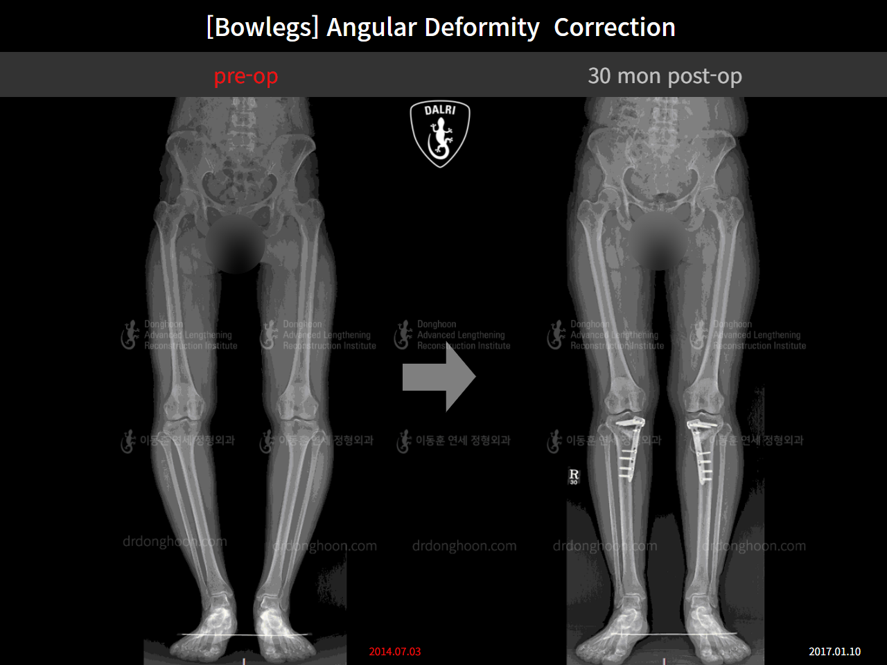 Before and after adult bowlegs, case 9289009, image 9, Dr. Donghoon institute (DALRI)