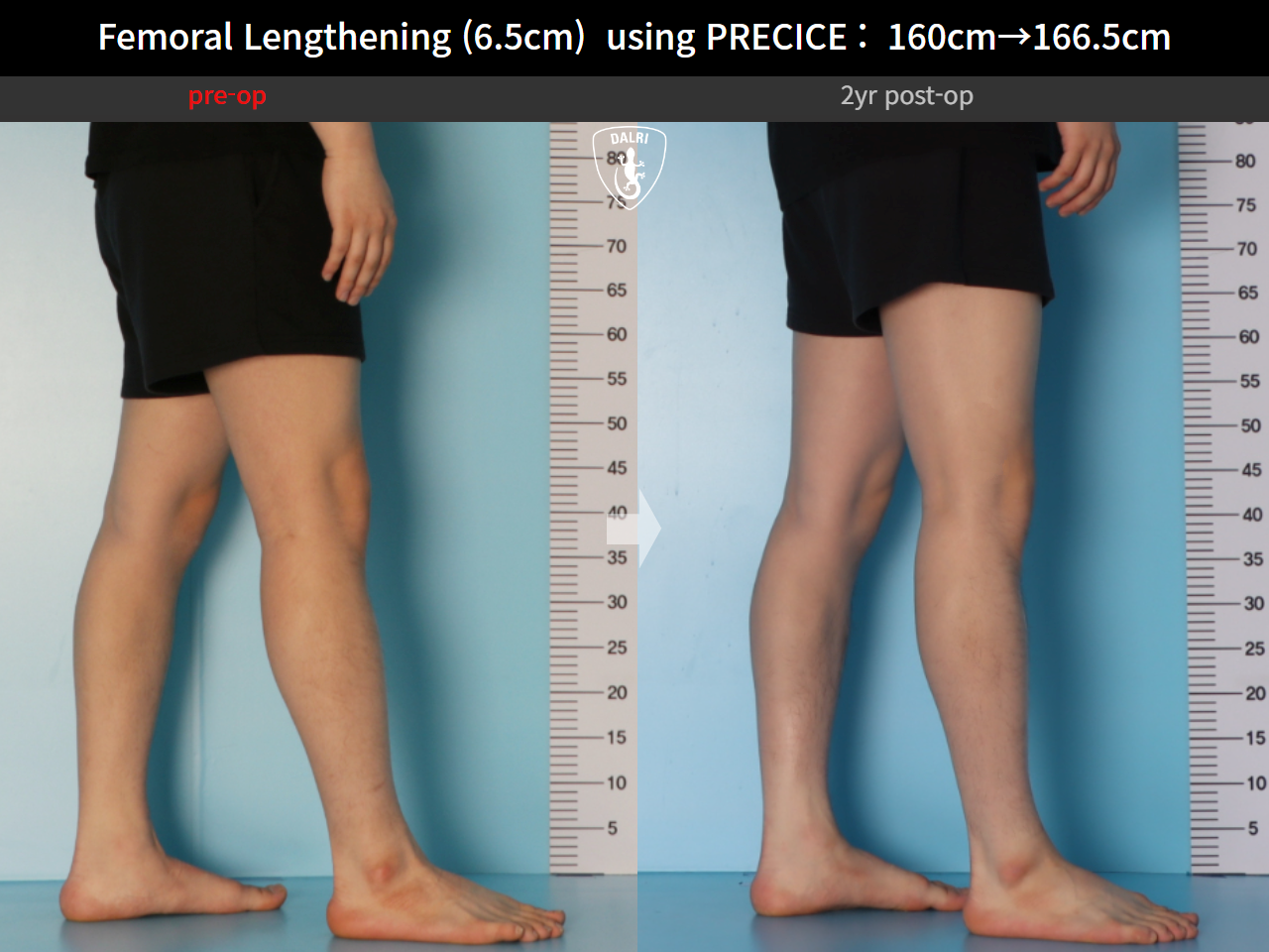 Before and after cll precice, case 27369651, image 9, Dr. Donghoon institute (DALRI)