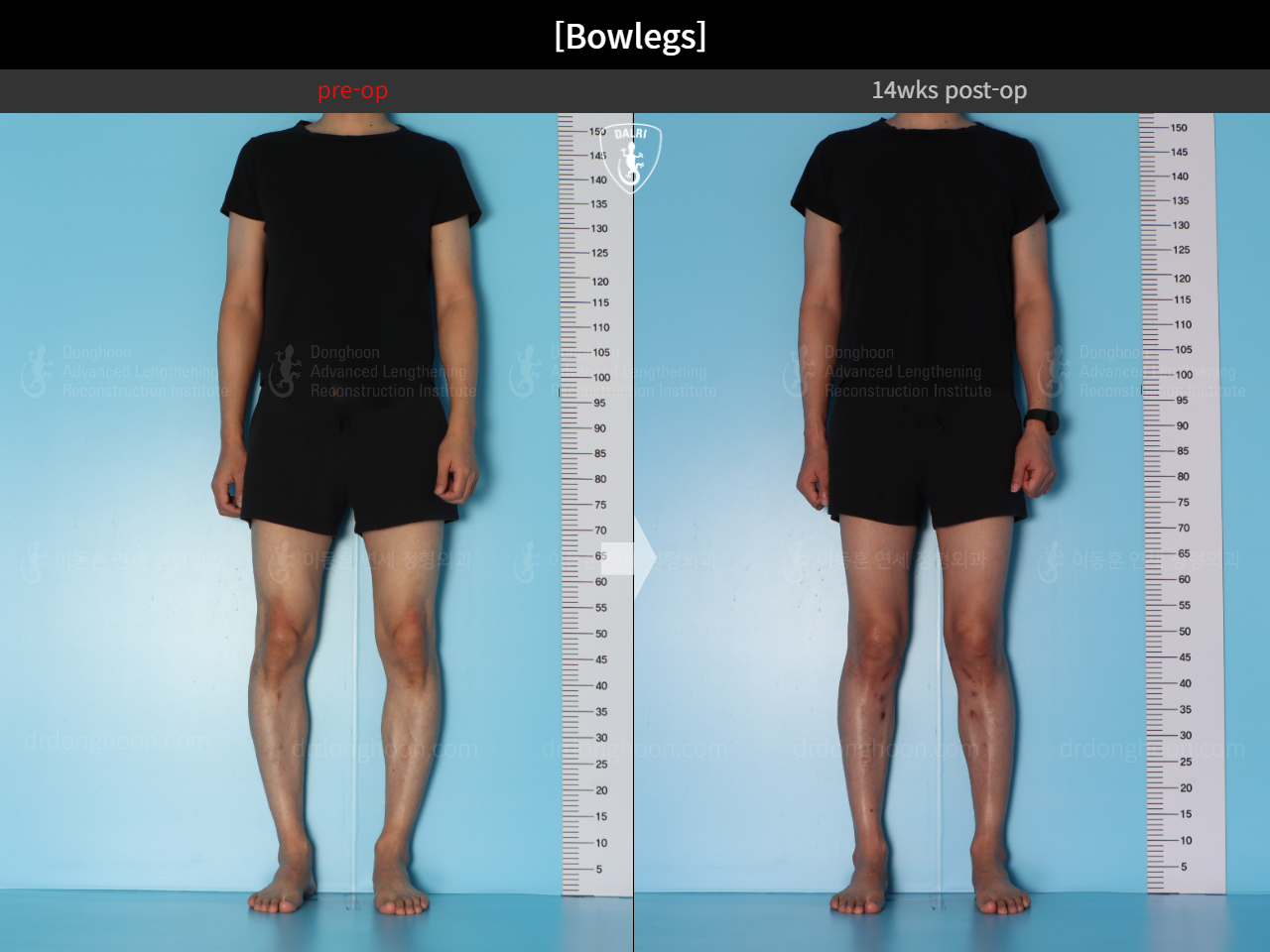 Before and after adult bowlegs, case 15512423, image 3, Dr. Donghoon institute (DALRI)