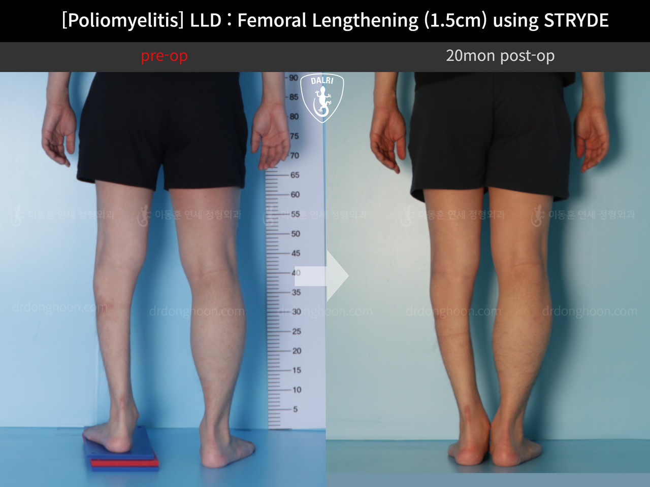 Before and after congenital condition, case 12335480, image 5, Dr. Donghoon institute (DALRI)