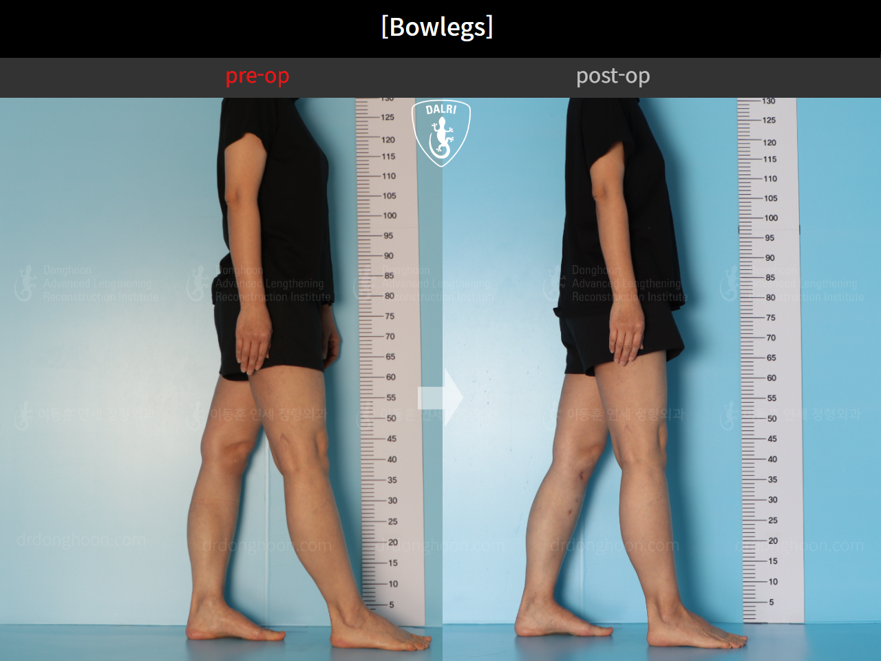 Before and after adult bowlegs, case 17463322, image 4, Dr. Donghoon institute (DALRI)