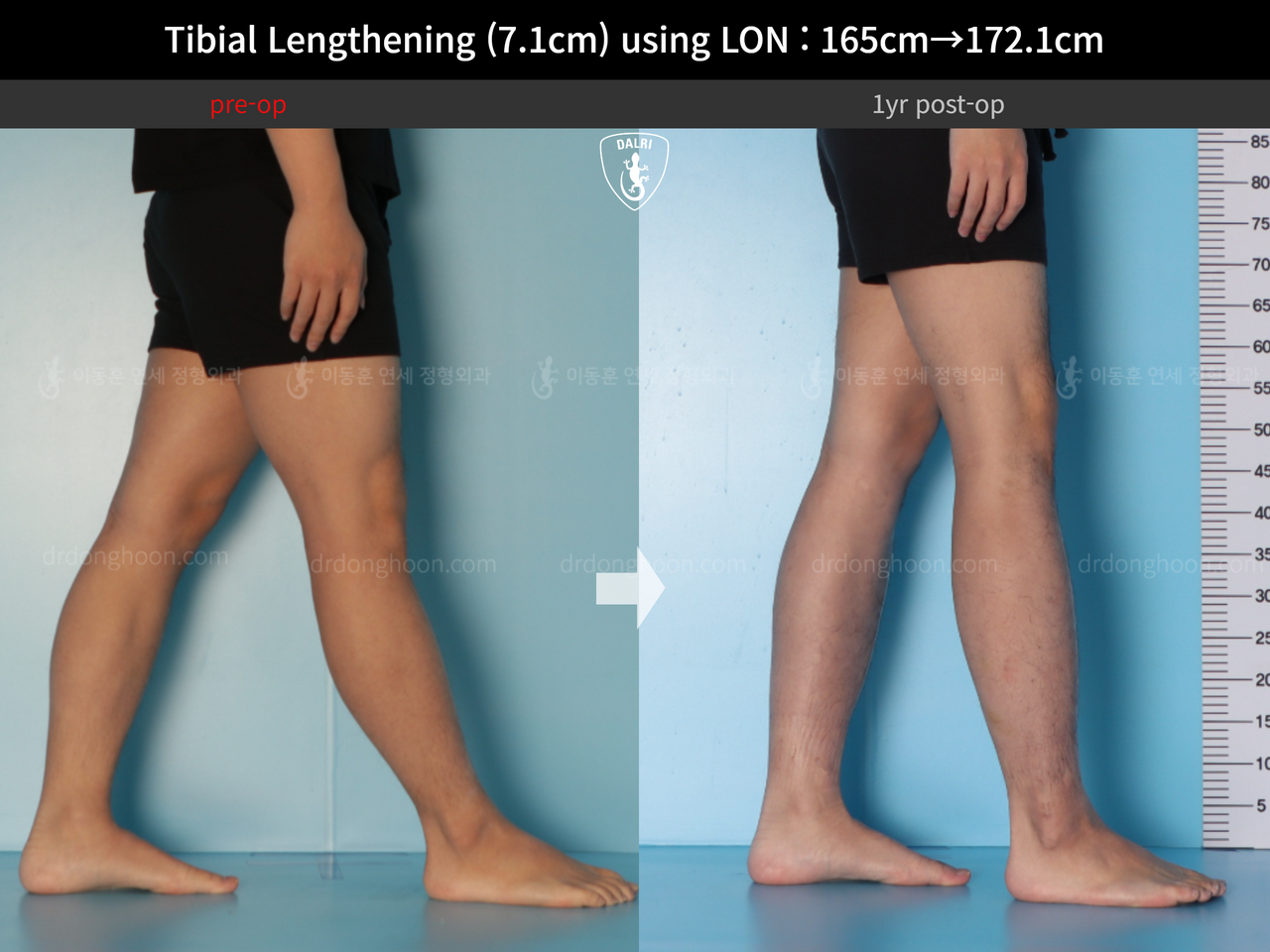 Before and after cll lon, case 14318674, image 9, Dr. Donghoon institute (DALRI)