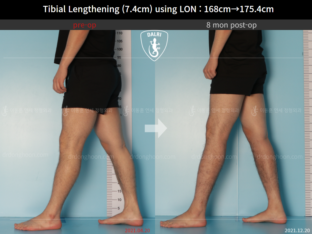 Before and after cll lon, case 9188051, image 8, Dr. Donghoon institute (DALRI)