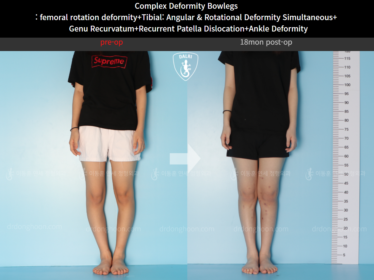 Before and after complex deformity, case 11244013, image 2, Dr. Donghoon institute (DALRI)