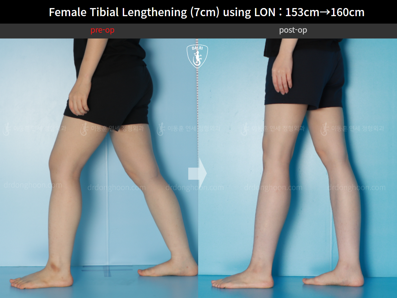 Before and after cll lon, case 16044134, image 7, Dr. Donghoon institute (DALRI)