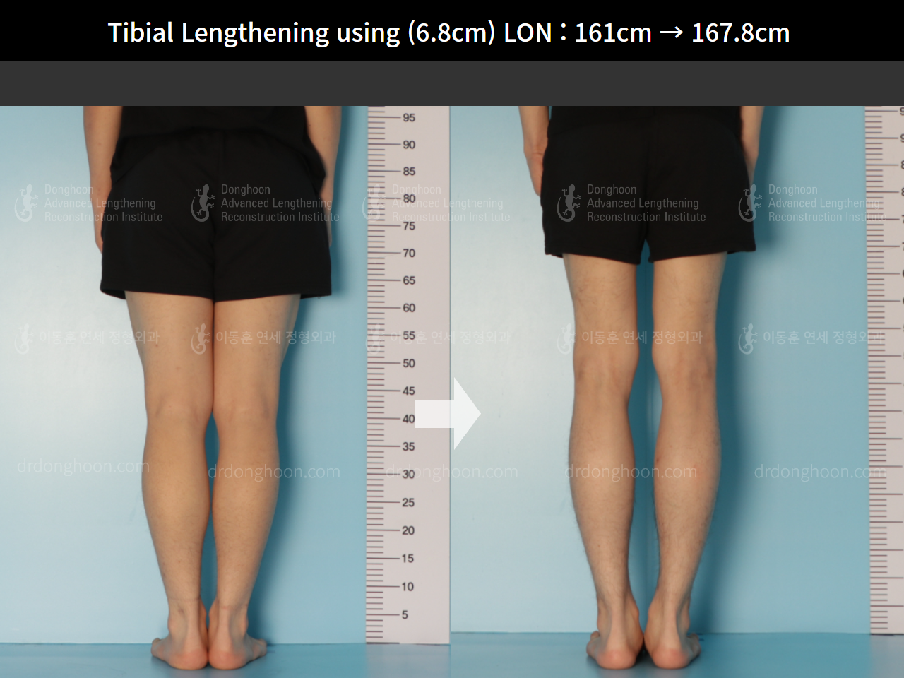 Before and after cll lon, case 8663720, image 6, Dr. Donghoon institute (DALRI)