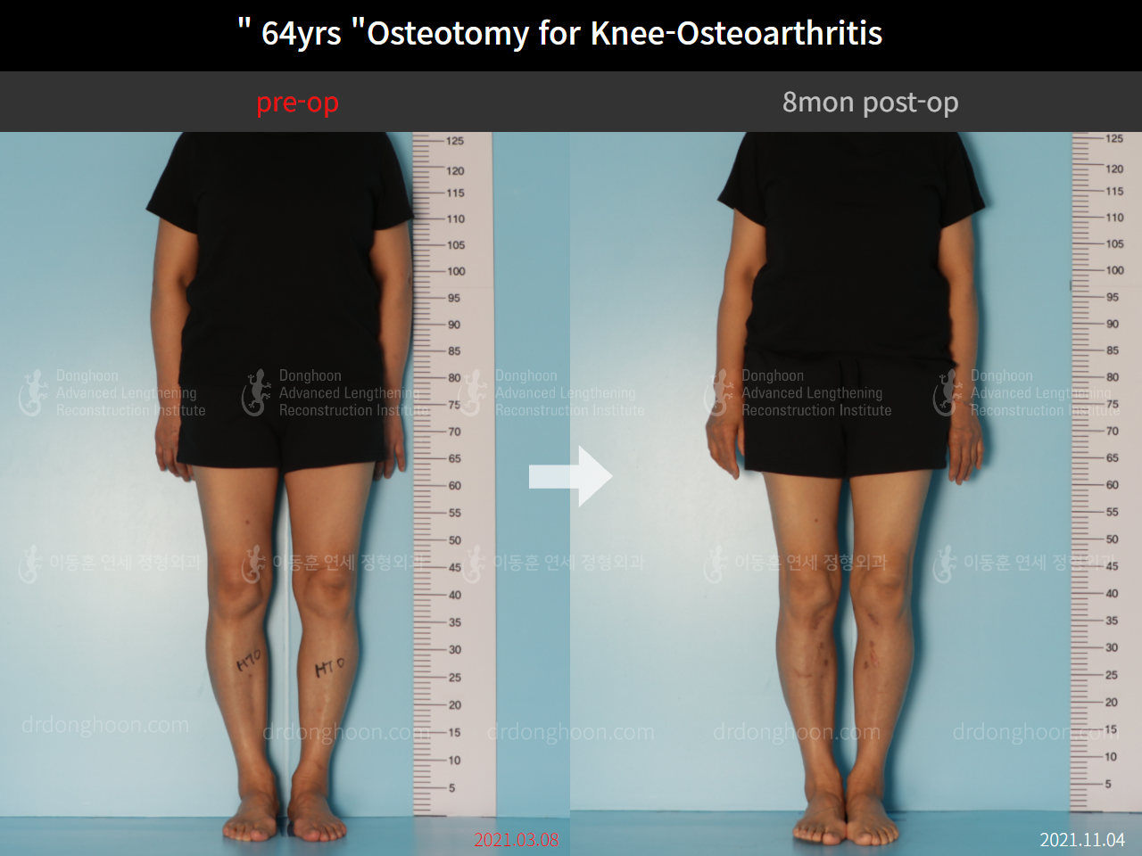 Before and after osteotomy for knee osteoarthritis, case 8761106, image 1, Dr. Donghoon institute (DALRI)