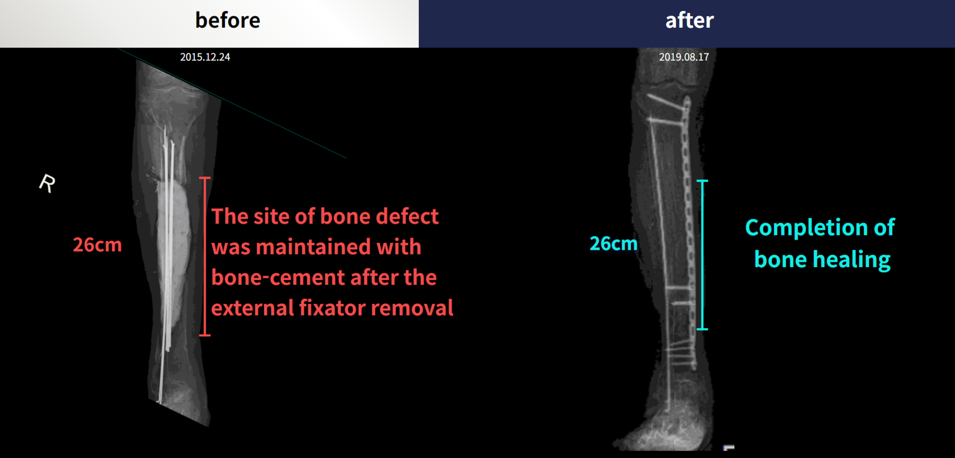 Before and after re-operation for cll, case 5200498, image 5, Dr. Donghoon institute (DALRI)