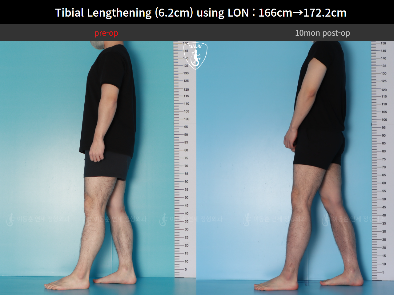 Before and after cll lon, case 128591201, image 5, Dr. Donghoon institute (DALRI)