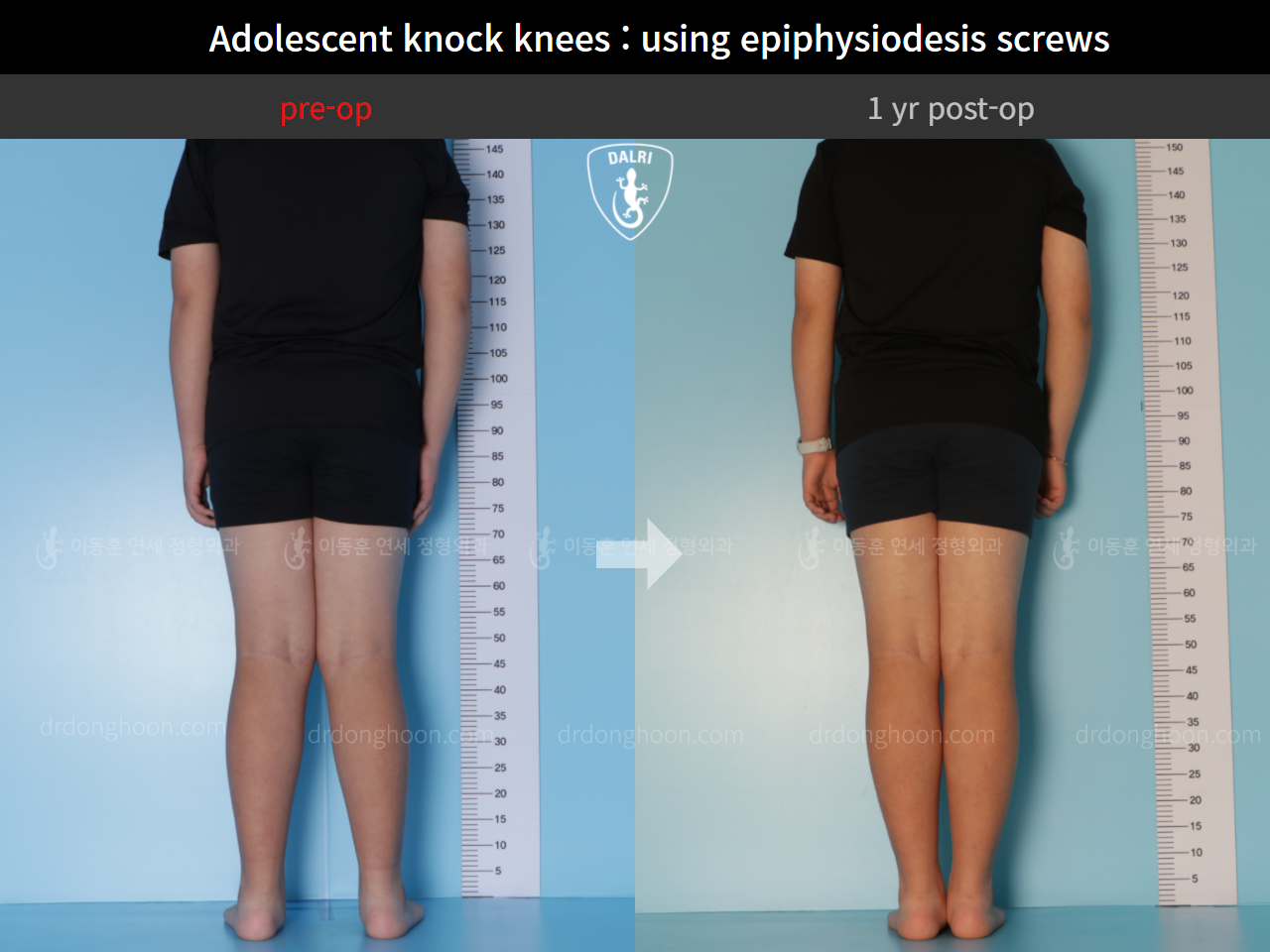 Before and after paediatric & adolescent knock knees, case 9331989, image 2, Dr. Donghoon institute (DALRI)