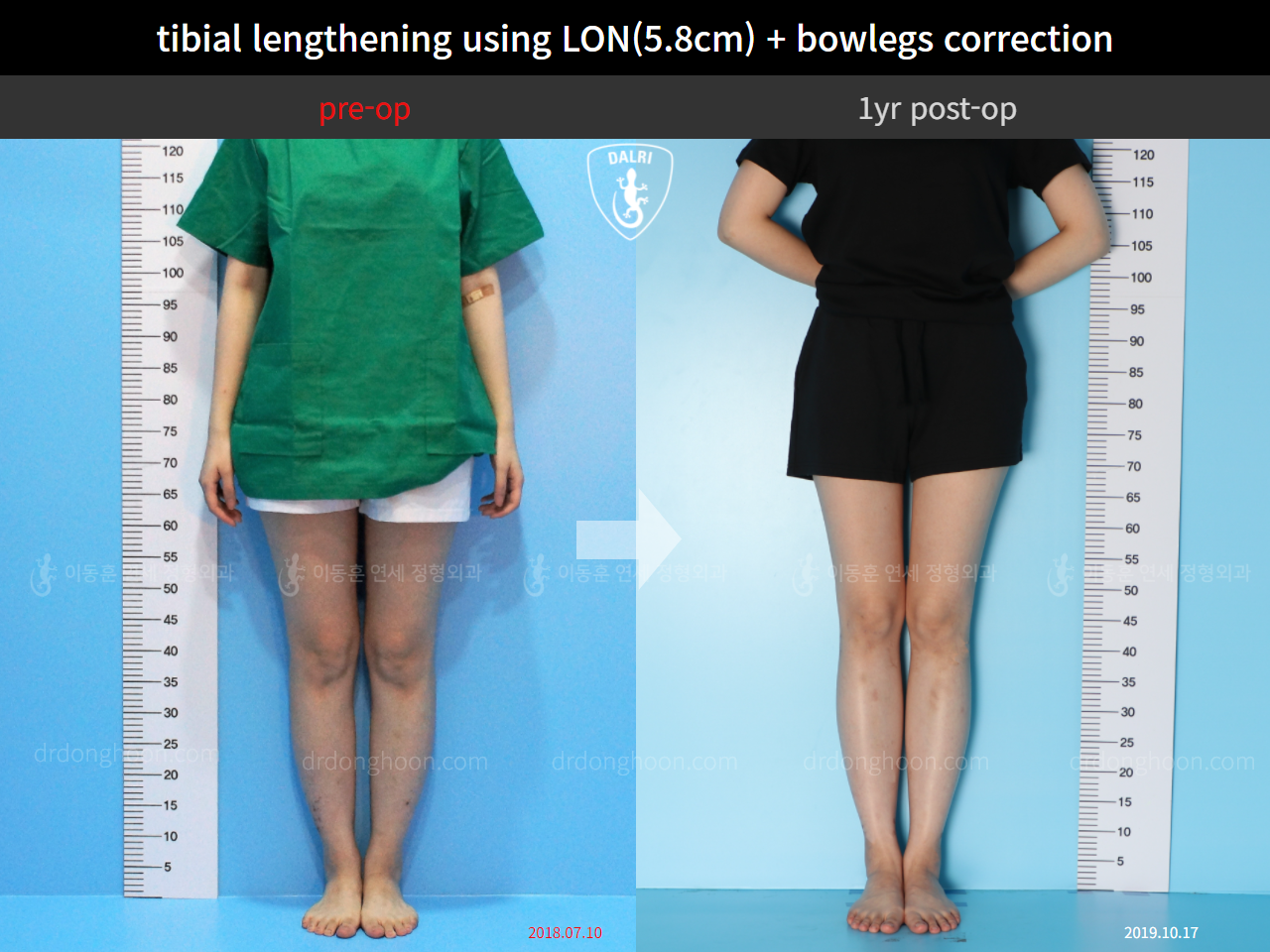 Before and after cll + deformity correction, case 11210566, image 1, Dr. Donghoon institute (DALRI)