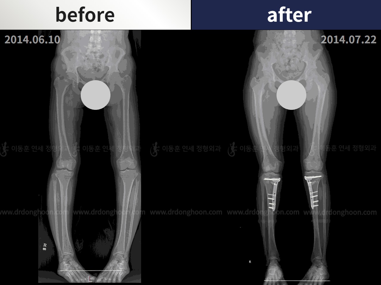Before and after paediatric & adolescent bowlegs, case 4320247, image 3, Dr. Donghoon institute (DALRI)