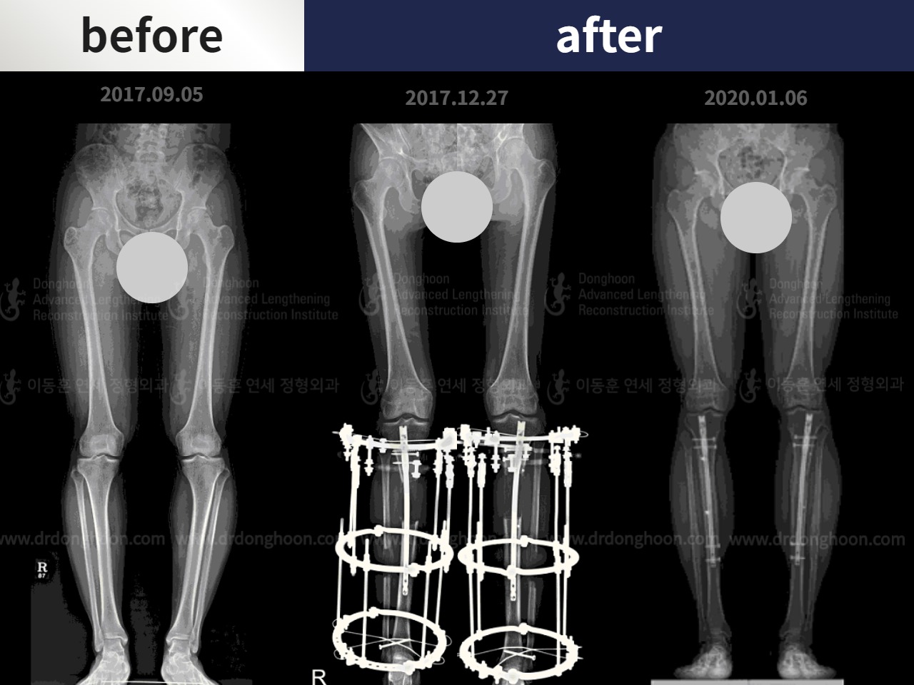 Before and after cll + deformity correction, case 4585631, image 3, Dr. Donghoon institute (DALRI)