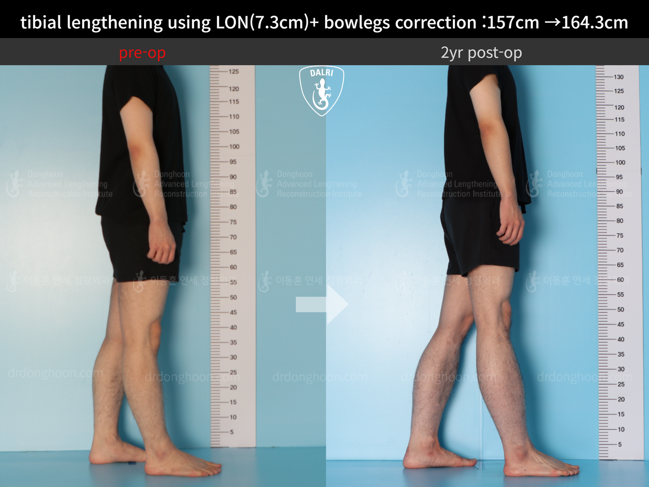 Before and after cll + deformity correction, case 13549500, image 3, Dr. Donghoon institute (DALRI)