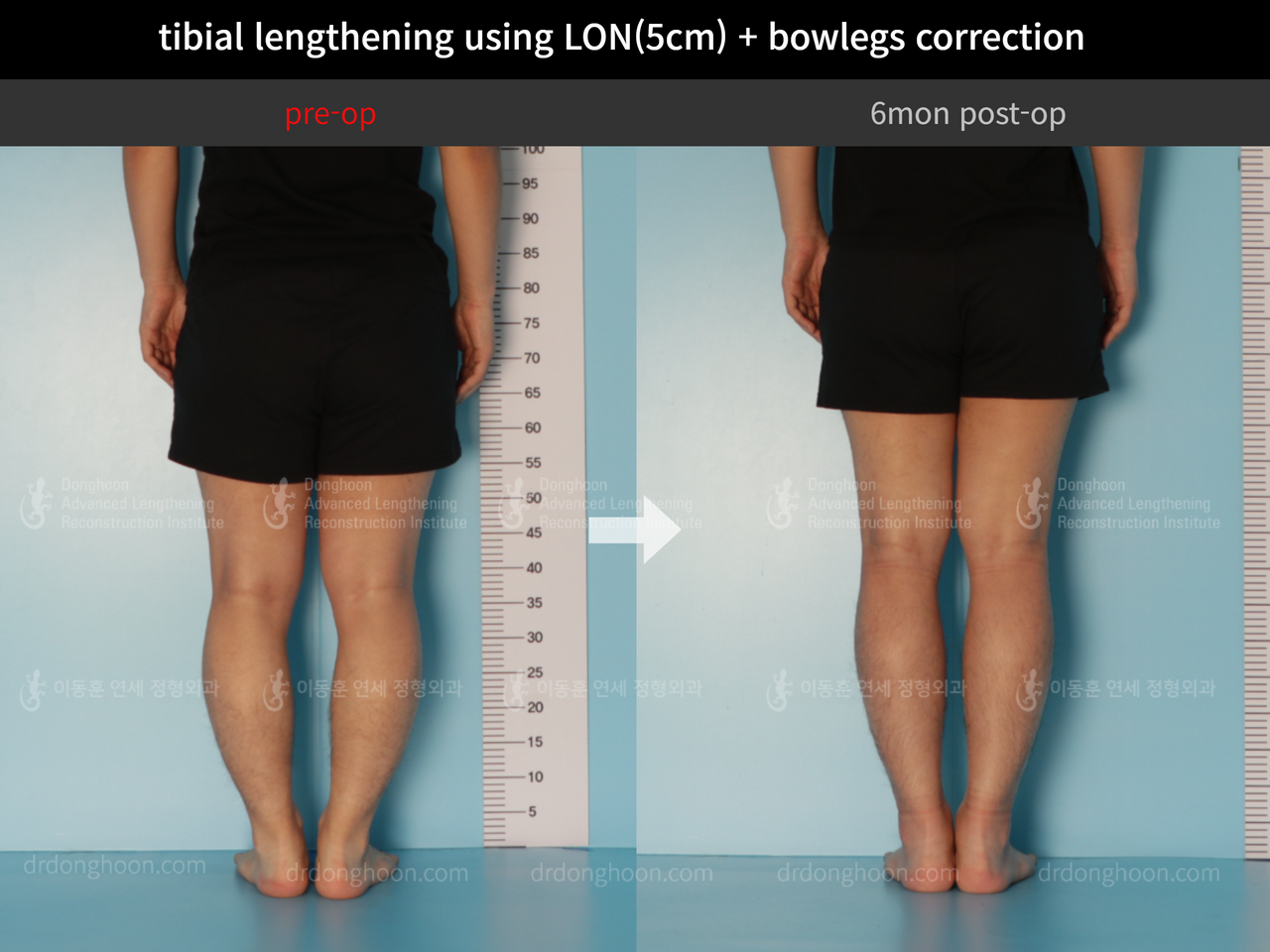 Before and after cll + deformity correction, case 11925306, image 6, Dr. Donghoon institute (DALRI)