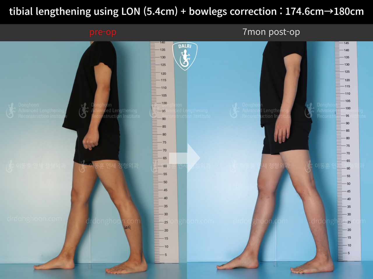 Before and after cll + deformity correction, case 12718558, image 6, Dr. Donghoon institute (DALRI)