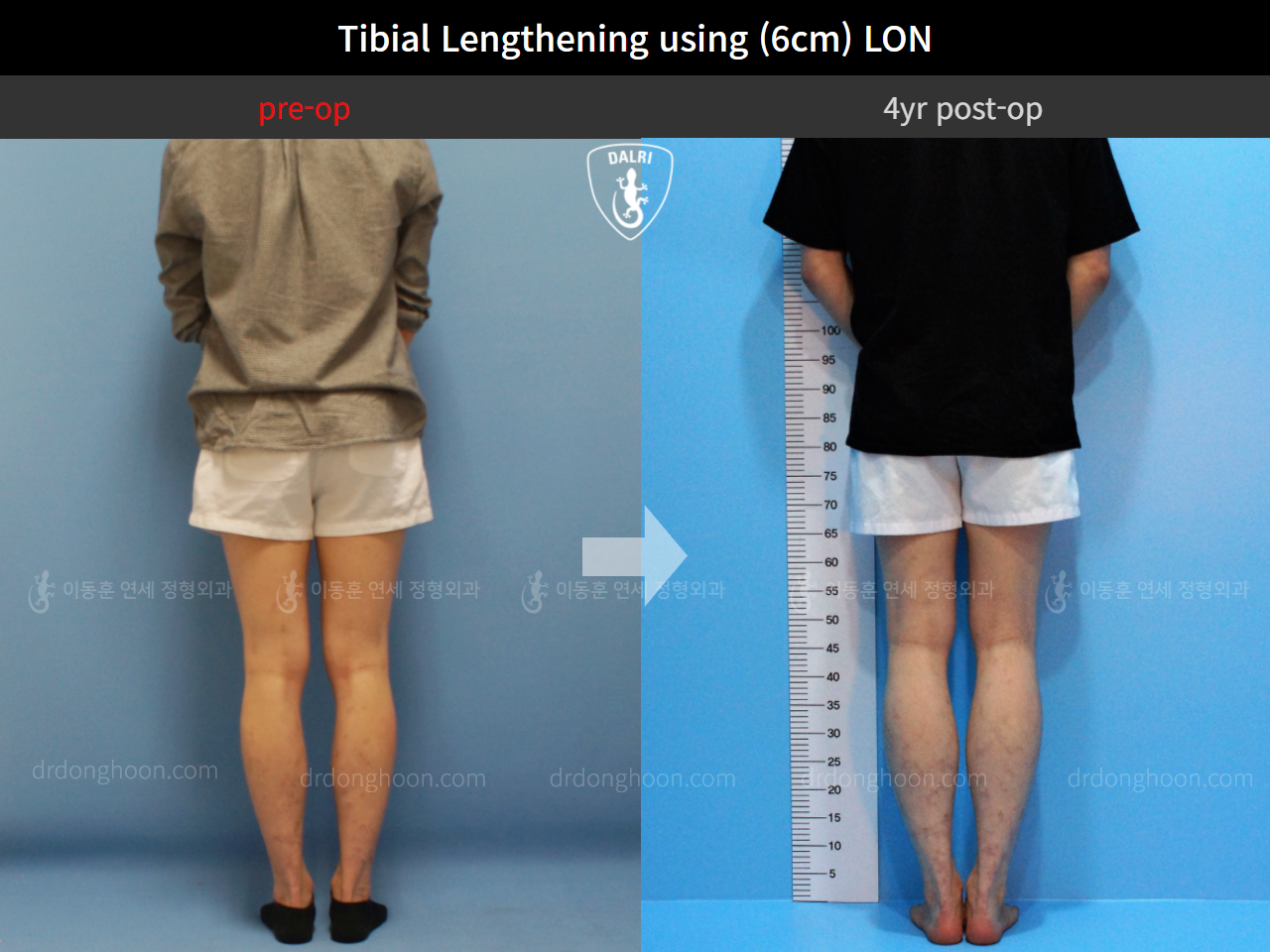 Before and after cll lon, case 4323452, image 4, Dr. Donghoon institute (DALRI)