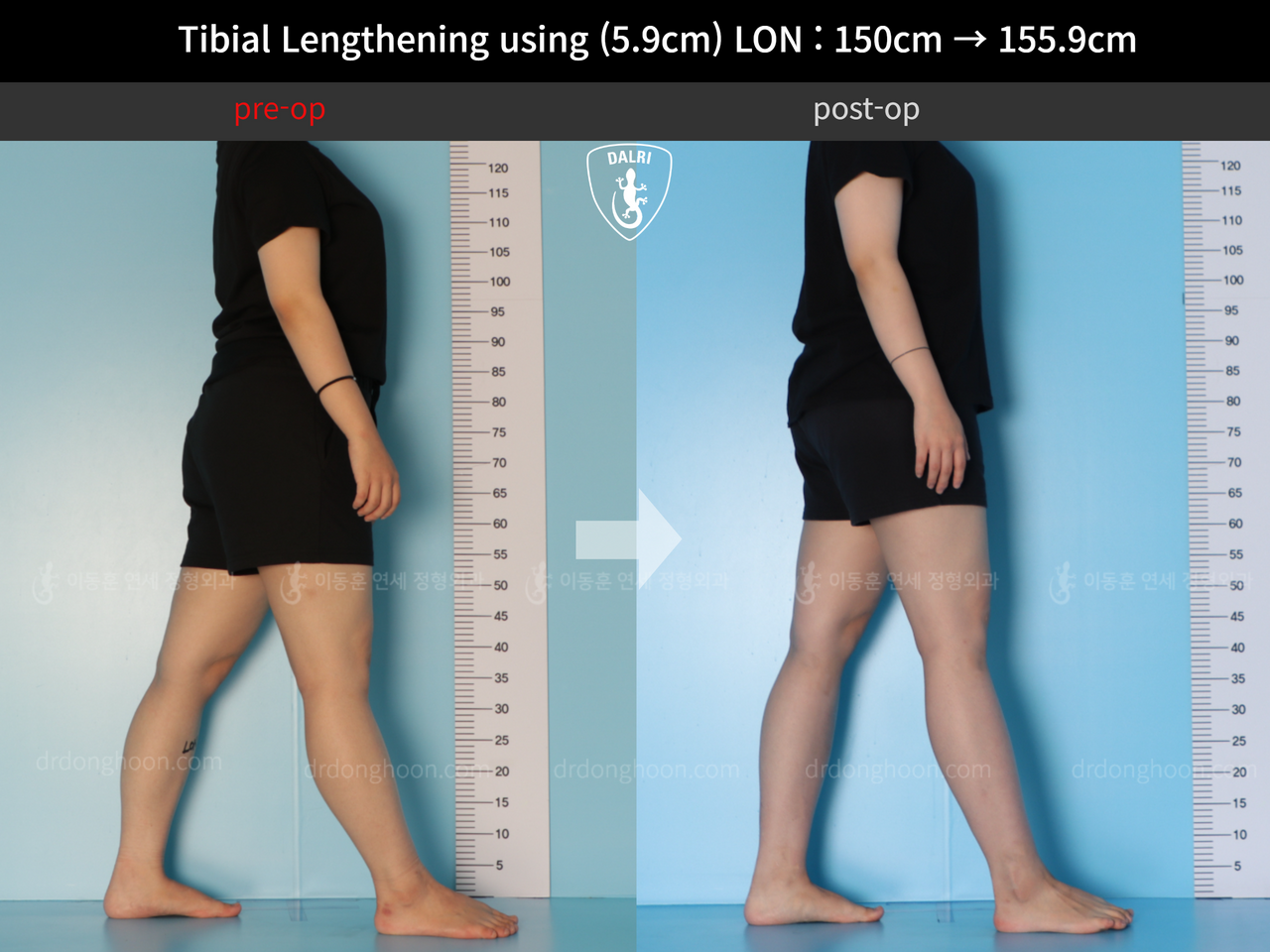 Before and after cll lon, case 12207071, image 3, Dr. Donghoon institute (DALRI)