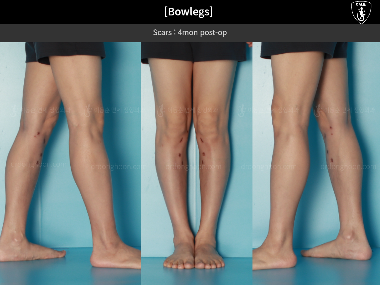 Before and after adult bowlegs, case 17962599, image 11, Dr. Donghoon institute (DALRI)