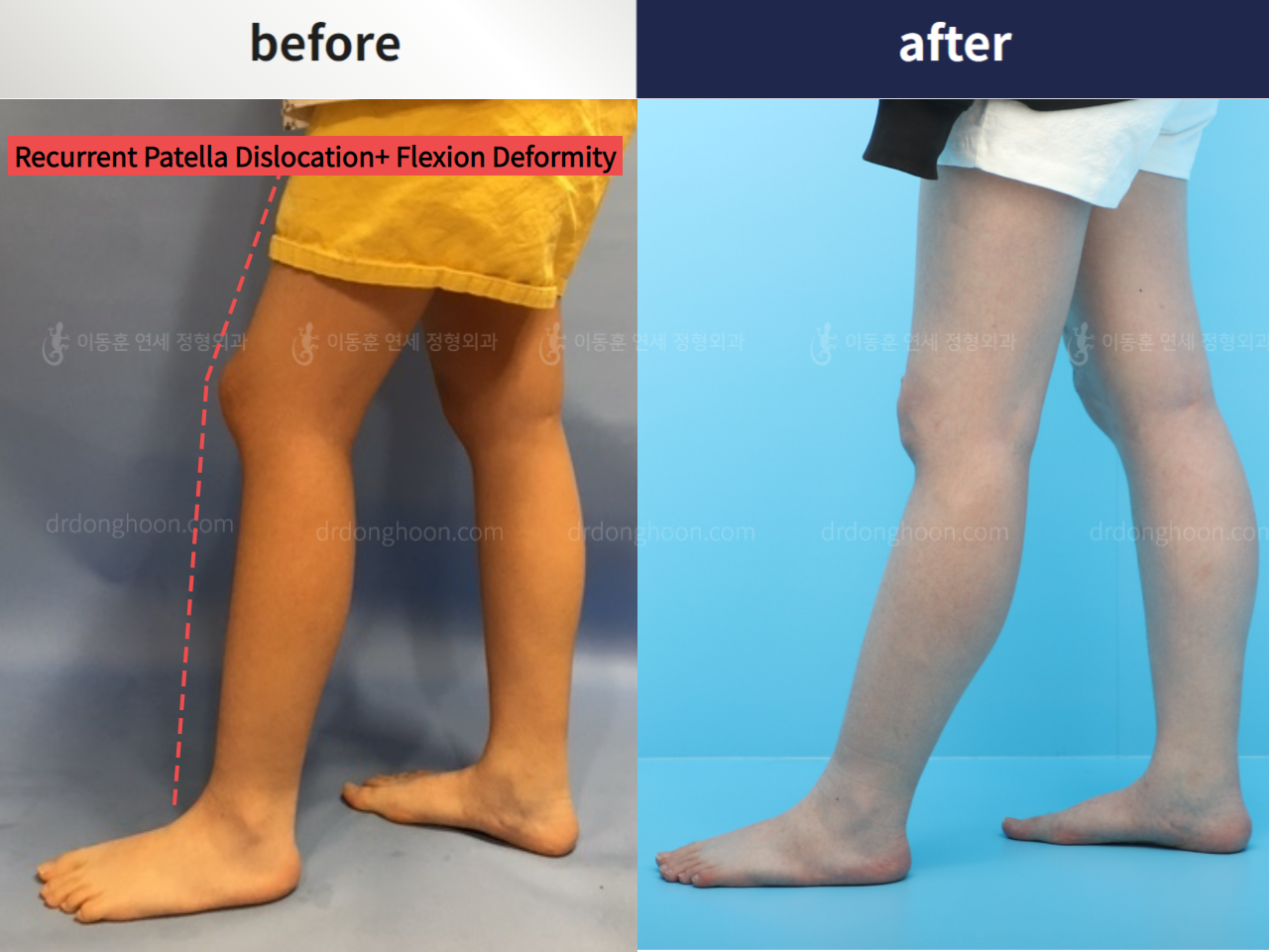 Before and after flexion deformity, case 4251742, image 1, Dr. Donghoon institute (DALRI)