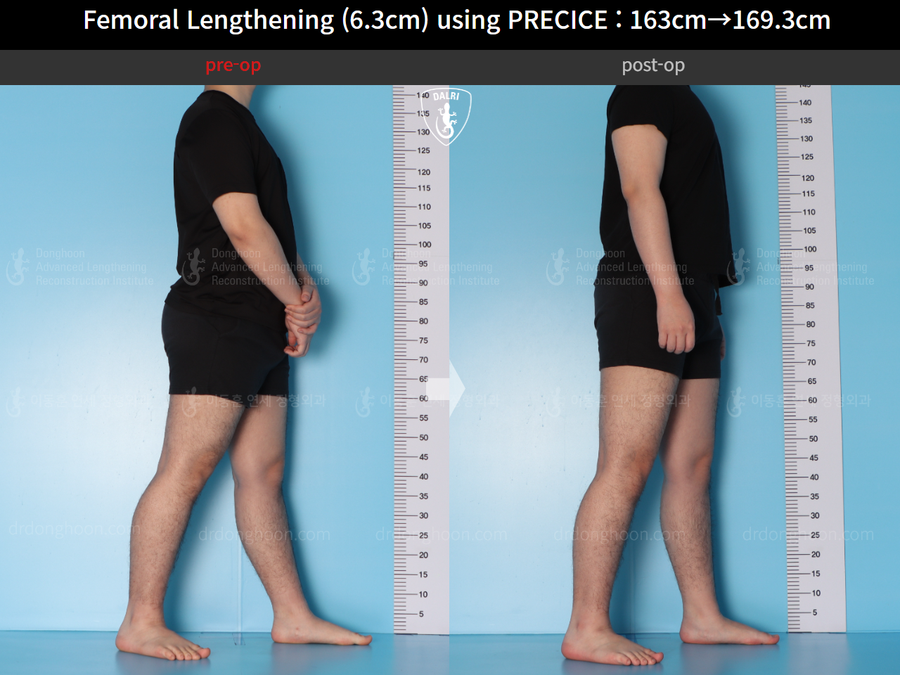 Before and after cll precice, case 15639837, image 7, Dr. Donghoon institute (DALRI)