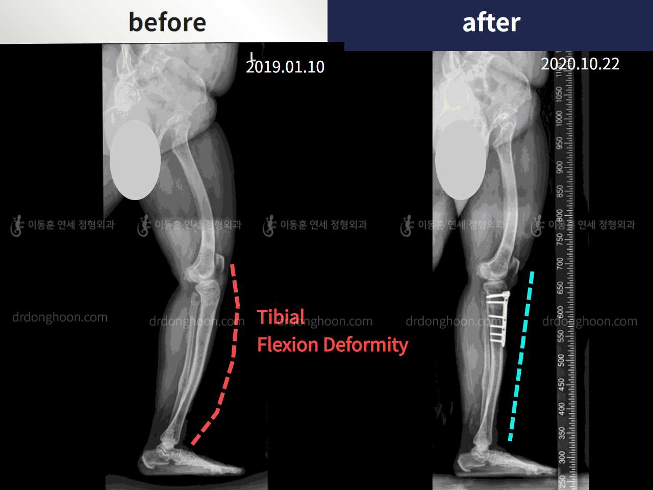 Before and after congenital condition, case 5271121, image 1, Dr. Donghoon institute (DALRI)