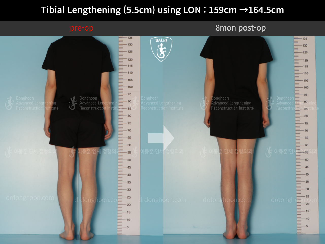 Before and after cll lon, case 10444923, image 2, Dr. Donghoon institute (DALRI)