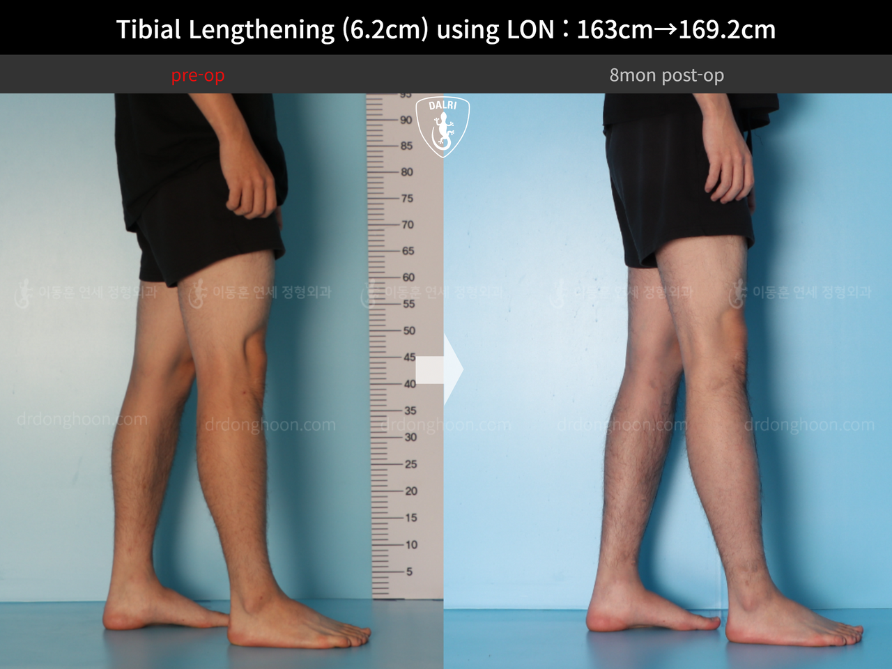 Before and after cll lon, case 14135787, image 9, Dr. Donghoon institute (DALRI)