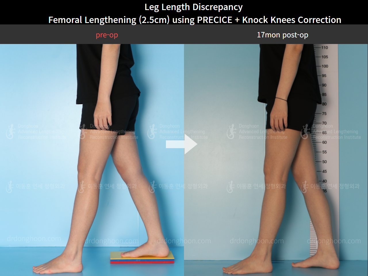 Before and after adult lld, case 8385191, image 3, Dr. Donghoon institute (DALRI)