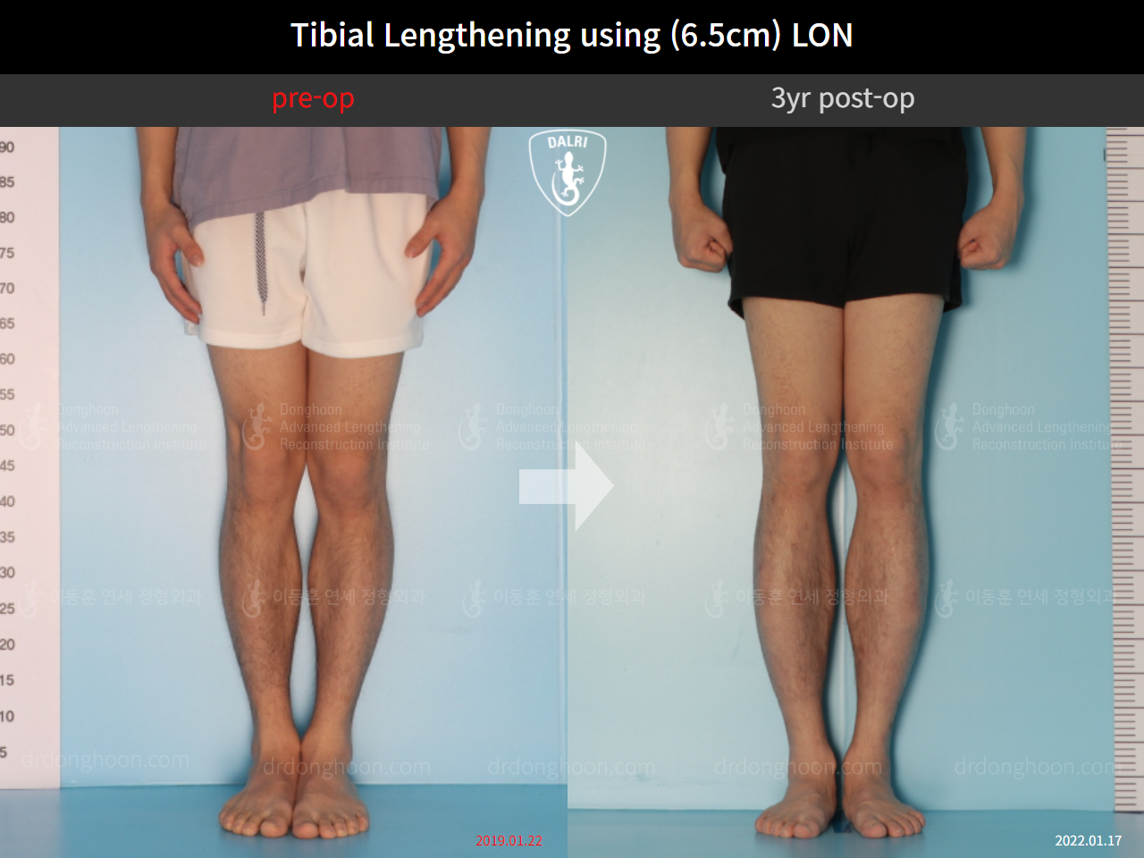 Before and after cll lon, case 9487829, image 5, Dr. Donghoon institute (DALRI)