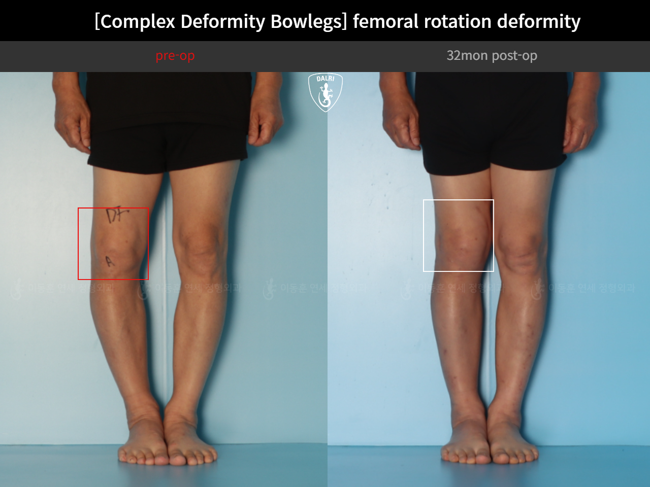Before and after adult bowlegs, case 35242887, image 10, Dr. Donghoon institute (DALRI)