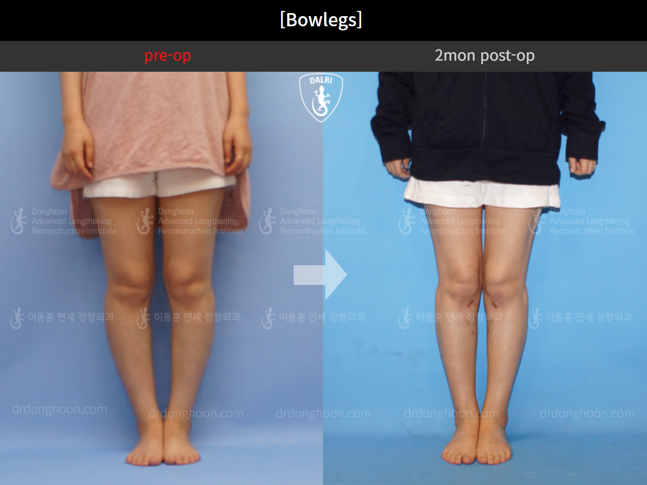 Before and after adult bowlegs, case 4310993, image 5, Dr. Donghoon institute (DALRI)