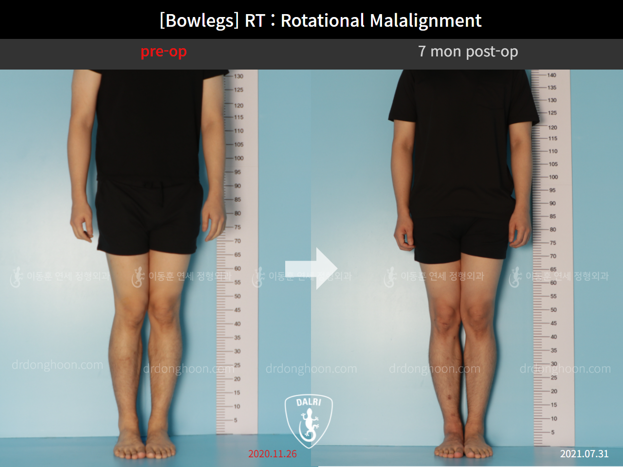 Before and after adult bowlegs, case 9190873, image 1, Dr. Donghoon institute (DALRI)
