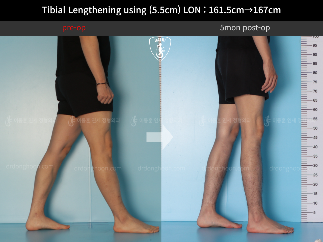 Before and after cll lon, case 12641751, image 7, Dr. Donghoon institute (DALRI)