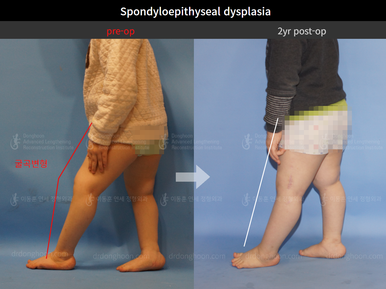Before and after paediatric congenital condition, case 4304778, image 3, Dr. Donghoon institute (DALRI)