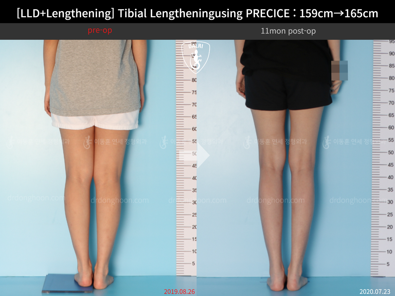 Before and after cll precice, case 13252418, image 6, Dr. Donghoon institute (DALRI)