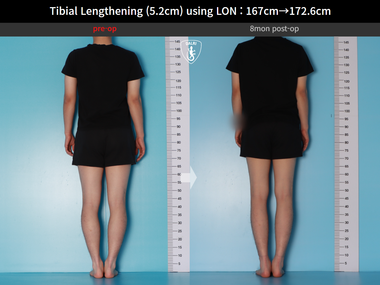 Before and after cll lon, case 29672720, image 2, Dr. Donghoon institute (DALRI)