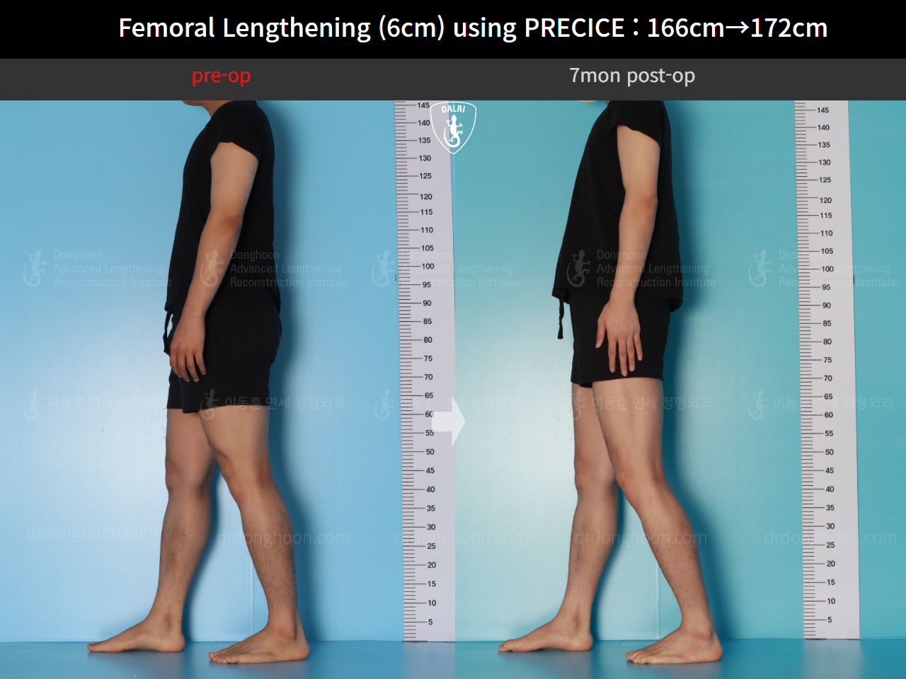 Before and after cll precice, case 17579263, image 3, Dr. Donghoon institute (DALRI)
