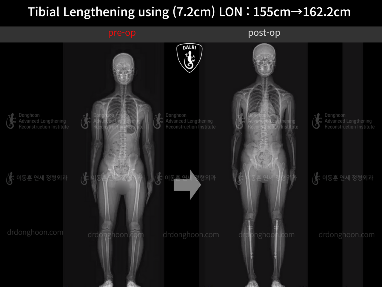 Before and after cll lon, case 13635674, image 11, Dr. Donghoon institute (DALRI)